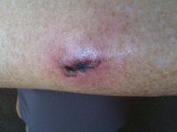 IMAG0200  There is my disgusting sore, still not healing over and continuing to swell. It was time to take action at the ER.