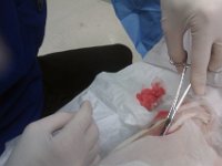IMAG0201  A little surgery to dig out the hematoma, then stuff some packing in with antibiotic on it. Dr. Lee and I  had a few laughs about why I didn't become a doctor - organic chemistry being the first of two insurmountable hurdles, the other being sputum. Apparently the latter is a common obstacle.