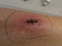 IMAG0202  Hematoma out, borders of redness marked, on second antibiotic now, and packing removed. This is painful - like an 8 out of 10 believe it or not - and hard to sleep. But happy to be making progress.