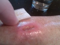 IMAG0260  Continuing to nurse this thing. Such an education in wound management! OMG. Never never never gash your shin. Well try to not get a hematoma due to tremendous force upon landing.