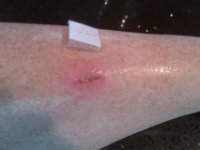 IMAG0261  Finally got a referral to the wound clinic at Tripler to get a jump on this thing. They put HONEY in it. Honey is a natural antibiotic, used as long ago as the Pharoahs. It biodegrades into H2O2 (hydrogen peroxide) slowly, keeping the pH of the wound too low for bacteria to grow. Love going to doctors and learning new things. This is not off-the-shelf honey, though. It's medical grade. I tend to keep cuts unbandaged and forget about them. That was the wrong move in this case. Needed to be kept moist or a hard eschar would form and prevent granulation tissue from growing up from the wound bed, allowing epithelialization to finally occur. This was a deep wound which would have been sutured if it hadn't been so old. So...very...interesting. But really - missing out on 8 weeks of water time during our last few months here. Painful.